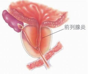 前列腺炎