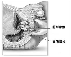 前列腺癌的危害有什么？