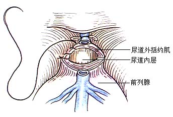 前列腺癌