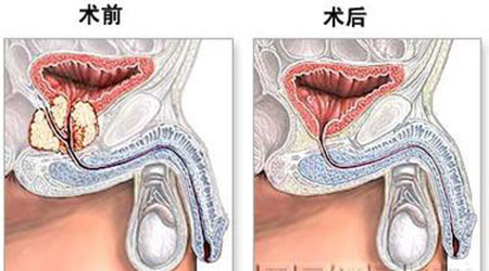 前列腺增生治疗