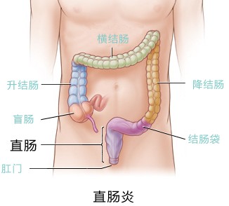 直肠炎