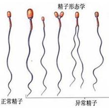 精子畸形拖延不治会带来的严重后果