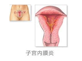 慢性子宫内膜炎发病时的症状