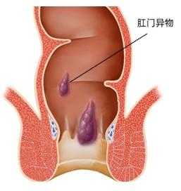 肛门异物会给患者造成的危害