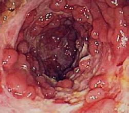 直肠炎给患者造成的危害