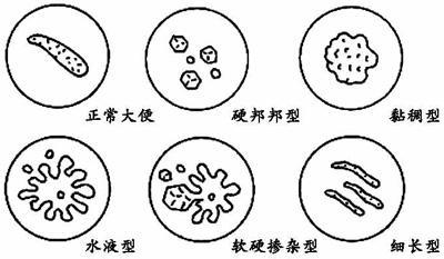 不同类型便秘的症状