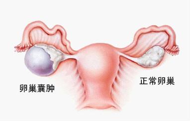 导致女性左侧出现卵巢囊肿的原因