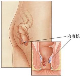 诱发内痔的原因