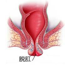 脱肛给患者带来的危害