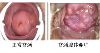 宫颈囊肿带来的危害